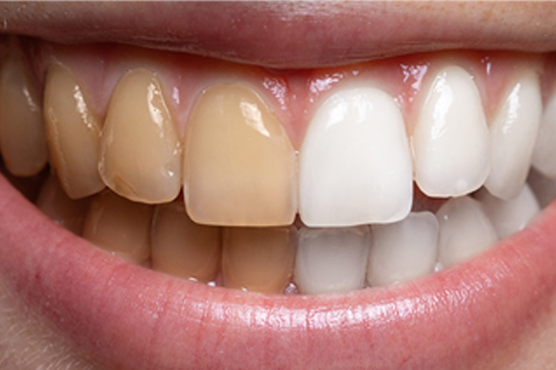 Special Dental Offer Van Nuys